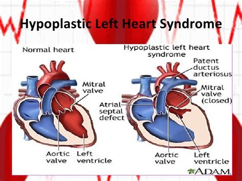 Cyanotic Heart Defects