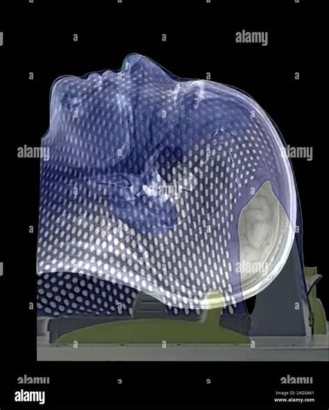 Tumor cerebral tratamiento de radioterapia 3D tomografía axial