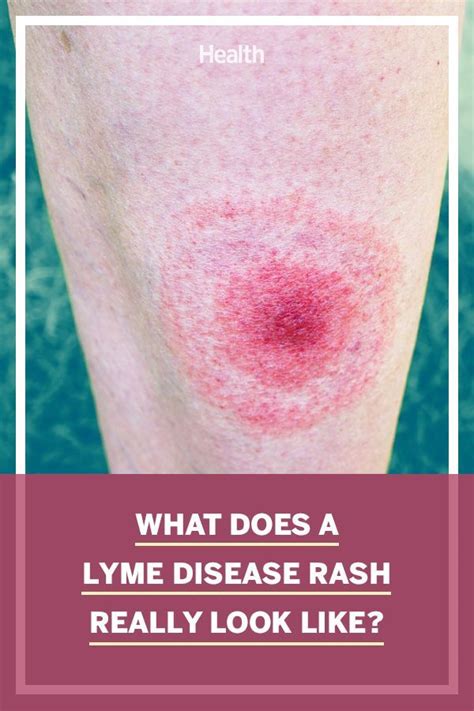 5 Types Of Rashes That Can Be Signs Of Lyme Disease Lyme Disease Types Of Rashes Lyme