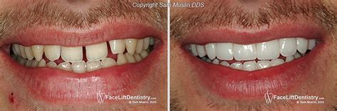 No Prep Porcelain Veneers To Widen Smile