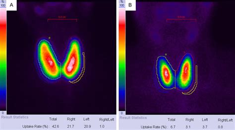 Thyroid Uptake Patients First Thyroid Scan A Showed Diffuse Goiter