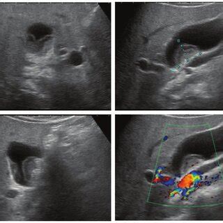 AUS showing thickened gallbladder wall and a structure of submucosal ...