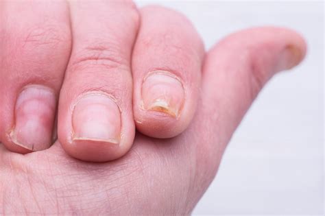 Psoriatic Nail Dystrophy Associated With Erosive Damage At DIP Joints