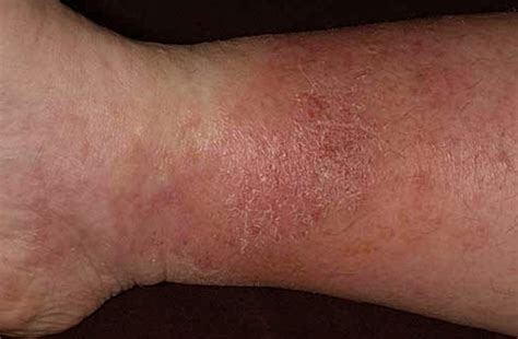 Stasis Dermatitis Pictures Causes And Treatment