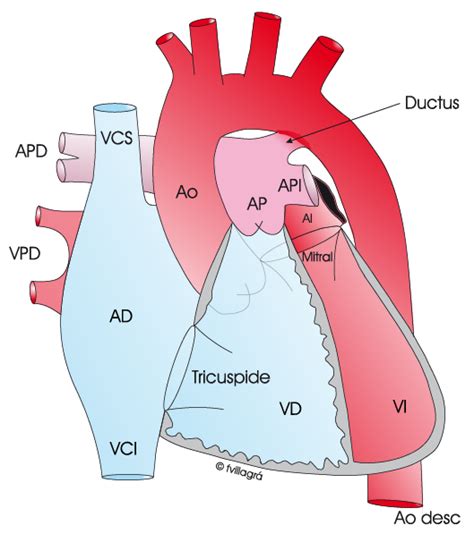 Ductus La Web De Las Cardiopatías Congénitas