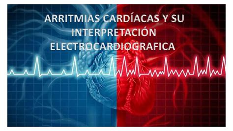 Arritmias Cardiacas y su Interpretación Electrocardiográfica Marleny