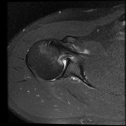 Reverse Hill-Sachs and Bankart lesion | Radiology Case | Radiopaedia.org