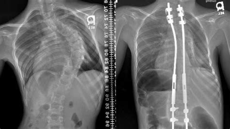 Searching For The Best Treatment For Early Onset Scoliosis