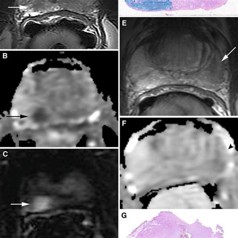 Multiparametric Prostate Mri Focus On T2 Weighted Imaging And Role In