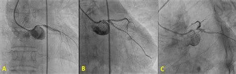 Angiography Revealed Severe Subocclusive Lesion In The Ostium Of Lmca