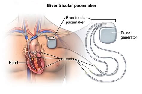 Pacemaker Basics Rebel Em Emergency Medicine Blog