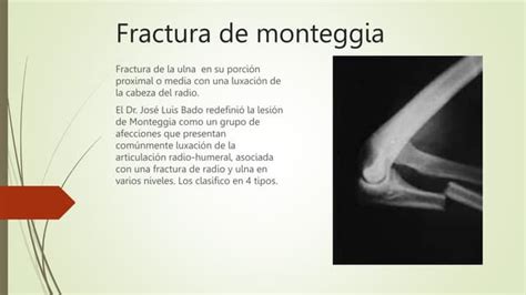 Fractura De Monteggia Preentacionpptx