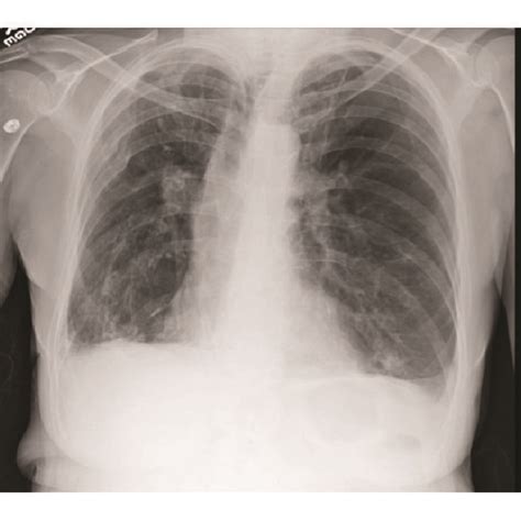 Baseline (a), during pseudomonas pneumonia (b), and follow-up (c) chest ...