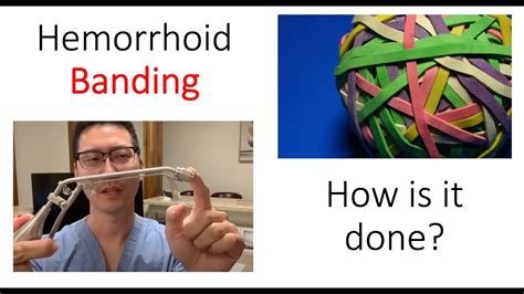 Hemorrhoid Banding Aftercare At Amy Oconner Blog