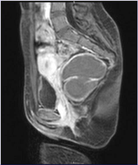 Magnetic Resonance Imaging Of Multiconcamerated Cyst Located In The