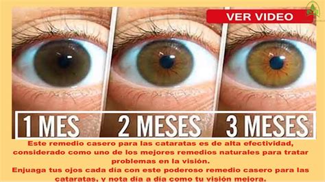 Poderoso Limpia Tus Ojos Reduce Las Cataratas Y Aumenta La Visi N En