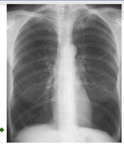 Pulm Exam Pulmonary Function Testing Flashcards Quizlet