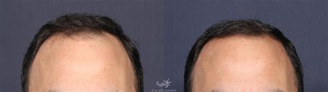 Smartgraft® Hair Restoration In San Diego Ca La Jolla Cosmetic