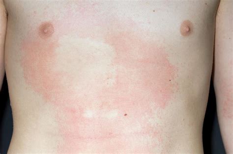 Urticaria Rash Photograph By Dr P Marazzi Science Photo Library