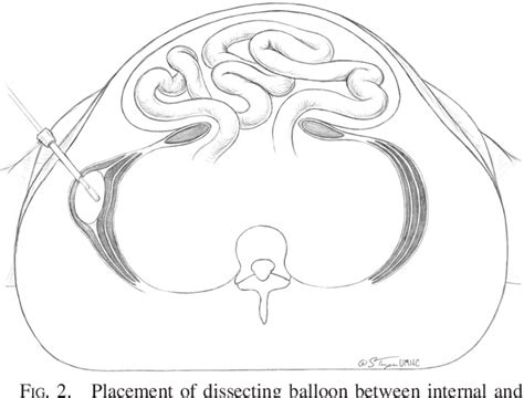 Figure 1 from Early Results of Midline Hernia Repair Using a Minimally Invasive Component ...