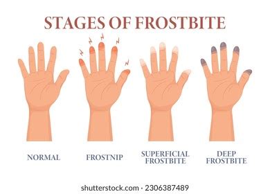 29 Vector Frozen Hands With Fingers. Medical Frostbite. Skin Burn ...