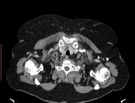 Current presentation -Lobulated heterogeneous thyroid gland. | Download ...