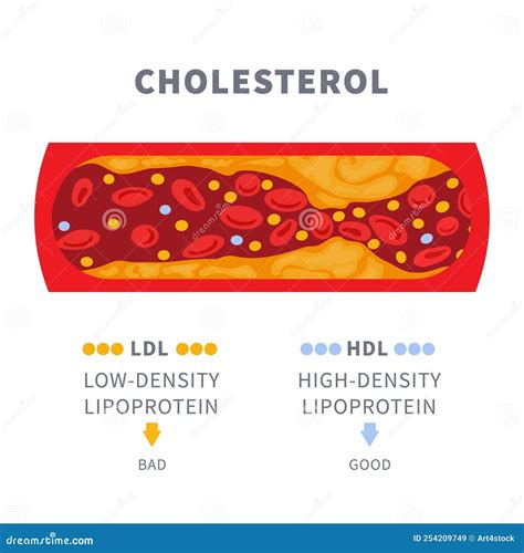 Cholesterol Plaque Buildup In Blocked Artery Diagram Cartoon Vector | CartoonDealer.com #254209749