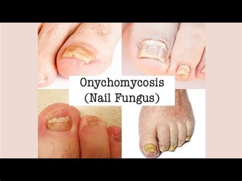 ONYCHOMYCOSIS: symptoms, treatment and prevention. - YouTube