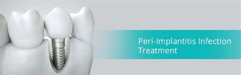 Peri Implantitis Treatment Luxden Implants Center Brooklyn Ny