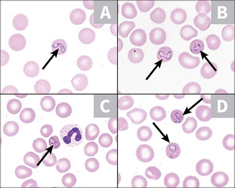 Babesiosis Clinicians Brief