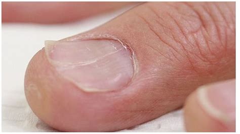 Iron Deficiency Anemia Nails