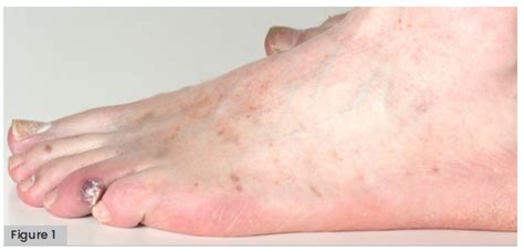 Hiv Negative Kaposi Sarcoma Manifesting As Foot Lesion In A Patient