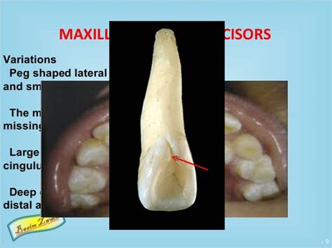 Permanent Maxillary Lateral Incisors