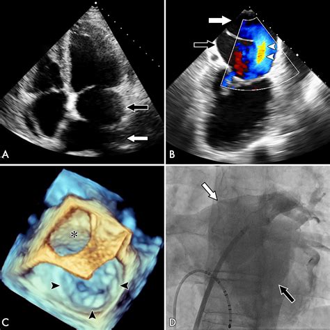 Multimodality Imaging Of Cor Triatriatum Sinister In An Adult