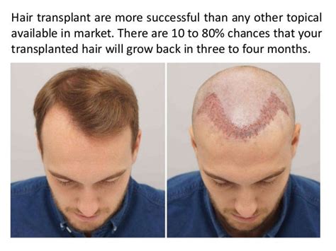 Success Rate Of Hair Transplants