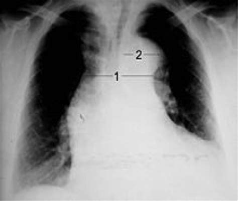 14 Diseases of the Aorta Flashcards | Quizlet