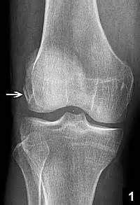 Lateral Condyle Femur Fracture