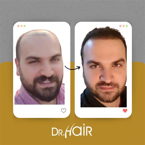 Best Hair Transplant In Istanbul Dr Hair