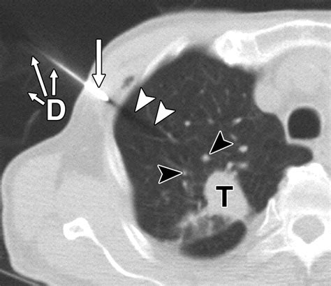 Ct Guided Core Biopsy Of Lung Lesions A Primer Ajr