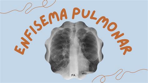 Enfisema Pulmonar En RadiologÍa Tele De TÓrax Signos RadiolÓgicos