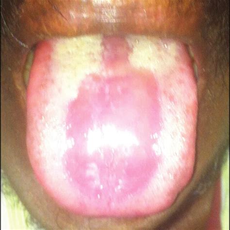 Erythematous Candidiasis With A Central Erythematous Smooth Appearance