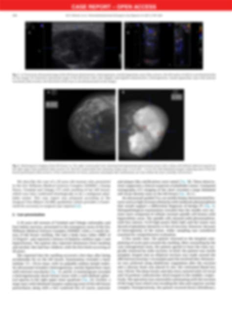 Solution Clinicopathology And Treatment Of A Giant Malignant Phyllodes