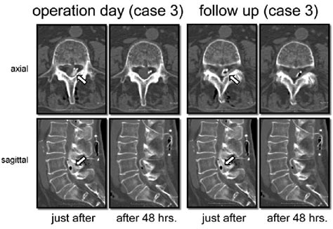 A Three Dimensional Computed Tomography 3d Ct Image Of The Lumbar Download Scientific Diagram