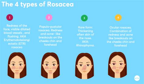 Rosacea Best Treatments According To Dermatologists Mdacne