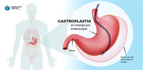 Gastroplastia En Manga Por Endoscopia Dr Camilo Ortiz Silva