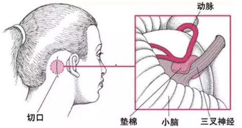 三叉神經痛到底有多痛？ 每日頭條