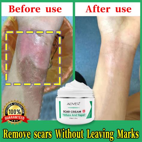 Aliver Scar Cream Effectively Remove Stretch Marks Acne And Burns Skin