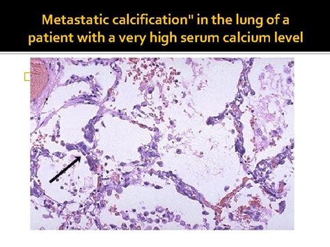 PATHOLOGIC CALCIFICATION Objectives Define calcification Types of ...