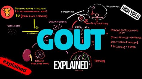 Gout Pathogenesis Eular Guideline Diagnostic Criteria X Ray Treatment