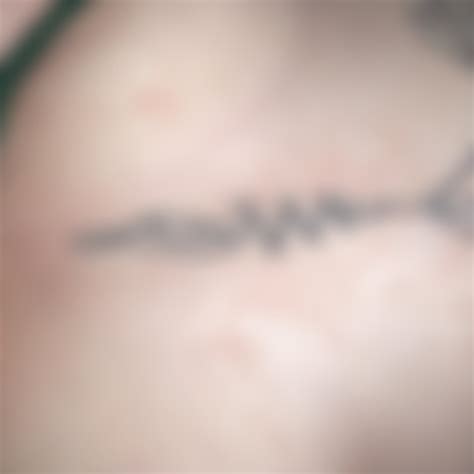 Rashes : r/lupus